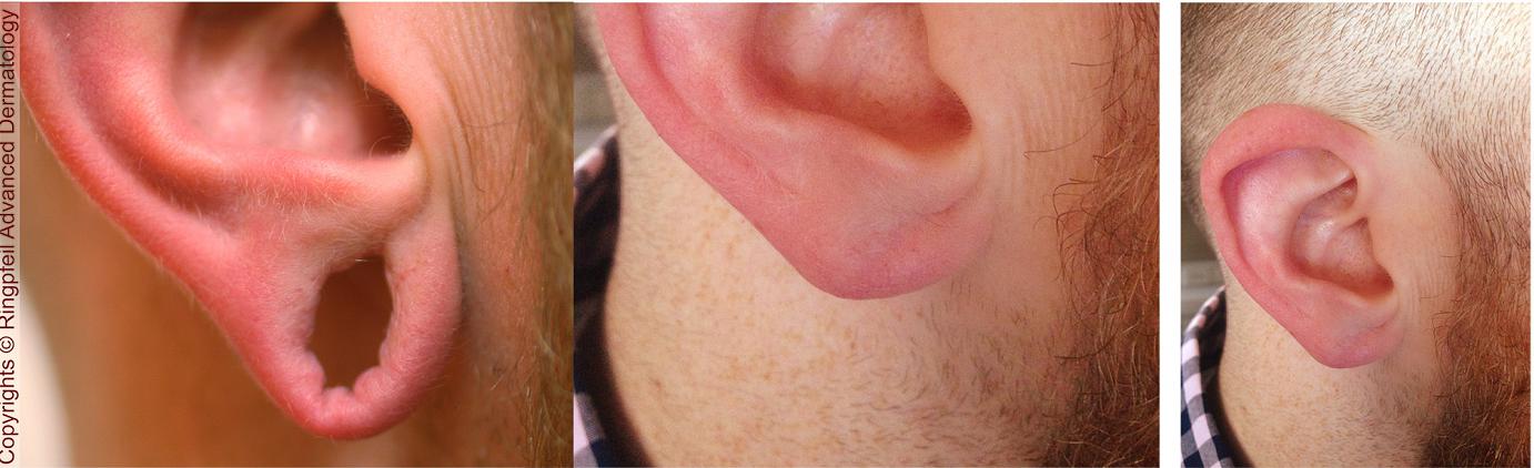 earlobe repair before and after